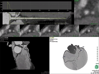 心臓CT