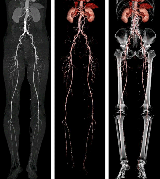 下肢動脈造影